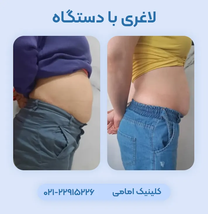 قبل و بعد لاغری با دستگاه