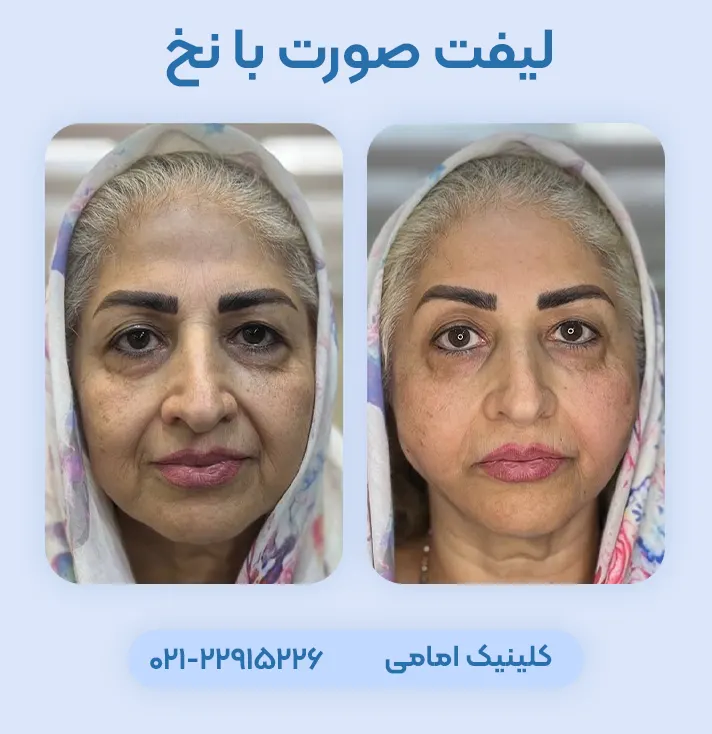 لیفت صورت با نخ