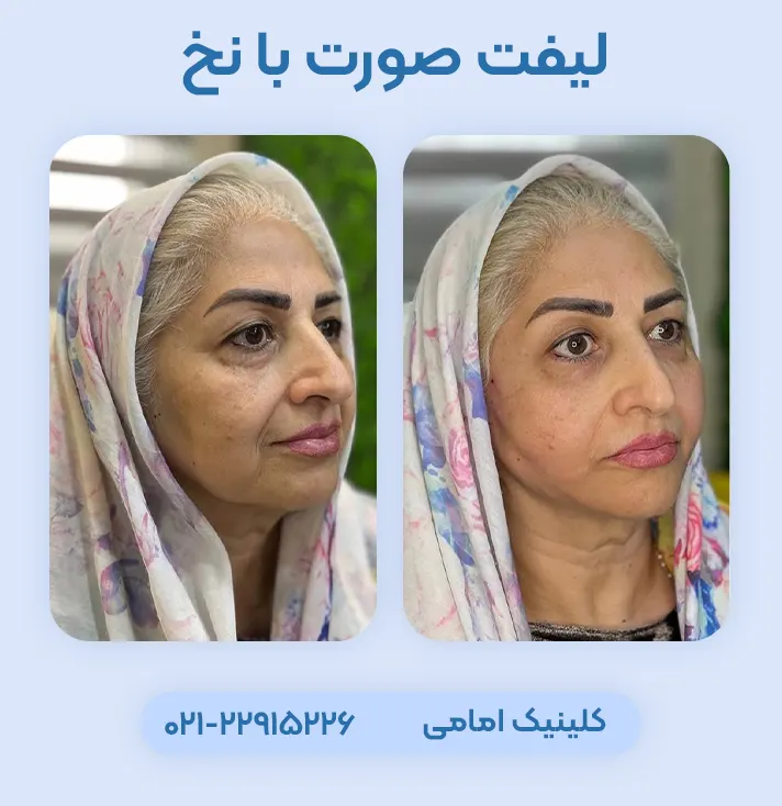 لیفت صورت با نخ