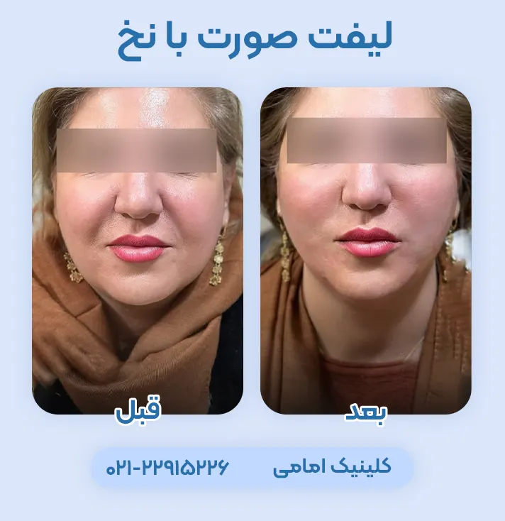 لیفت صورت با نخ