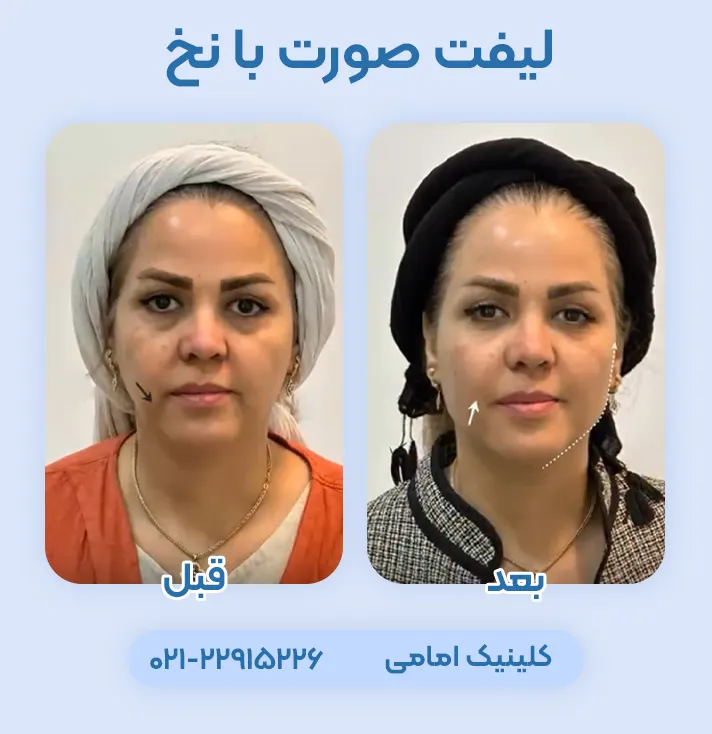 لیفت صورت با نخ
