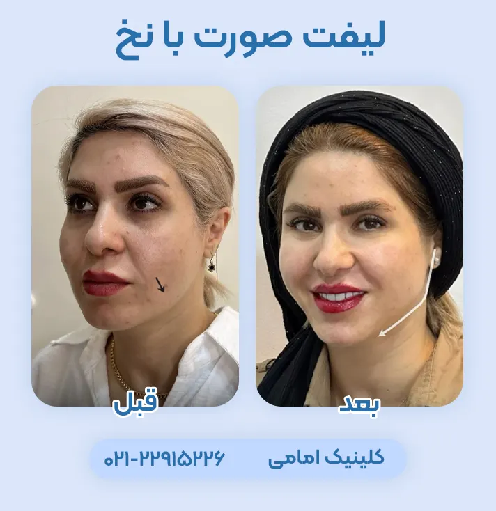 لیفت صورت با نخ