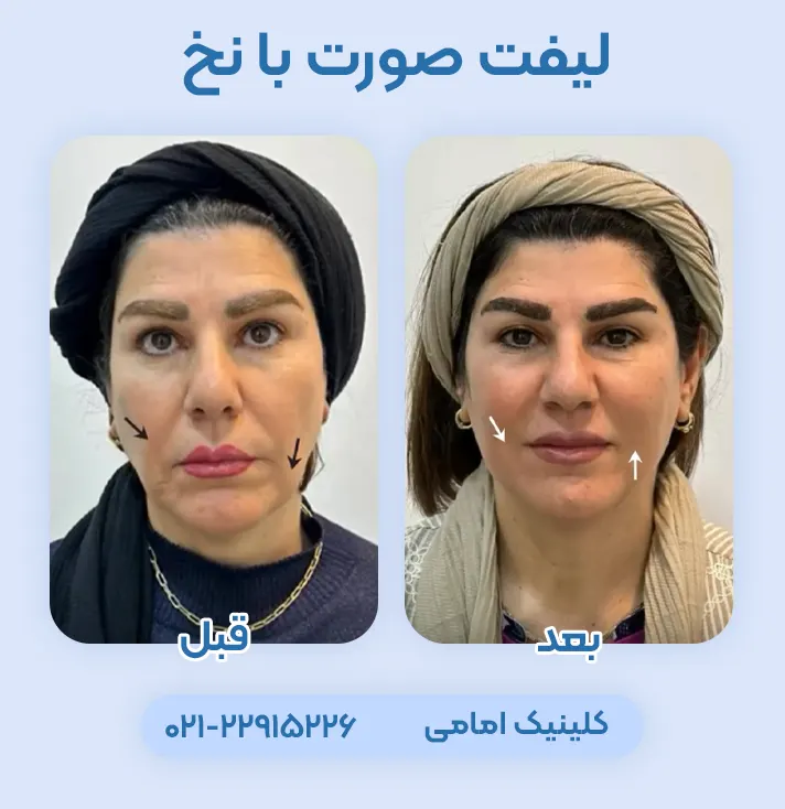 لیفت صورت با نخ