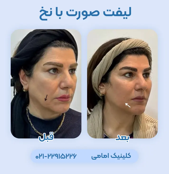 لیفت صورت با نخ