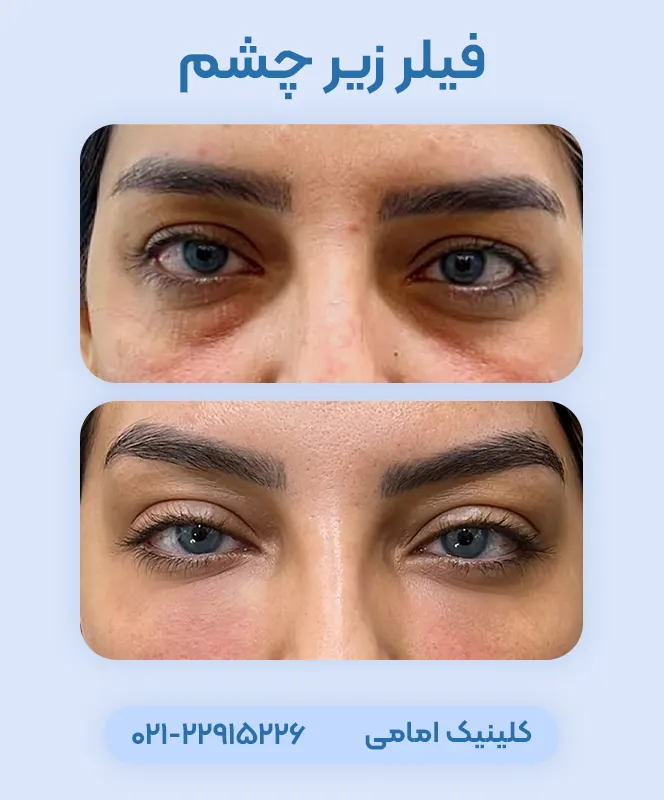 فیلر زیر چشم