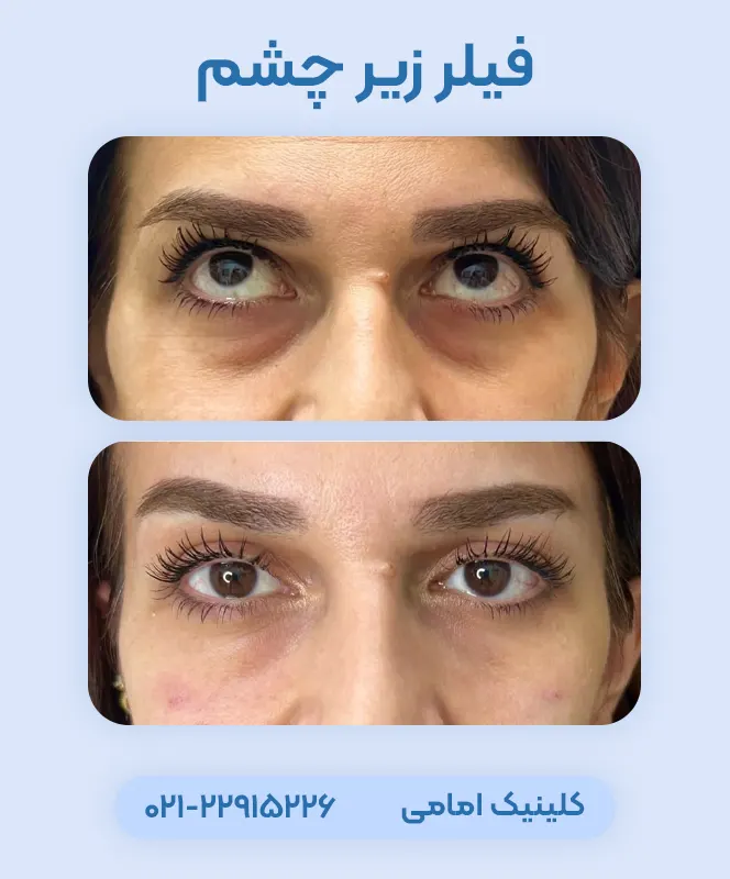 فیلر زیر چشم