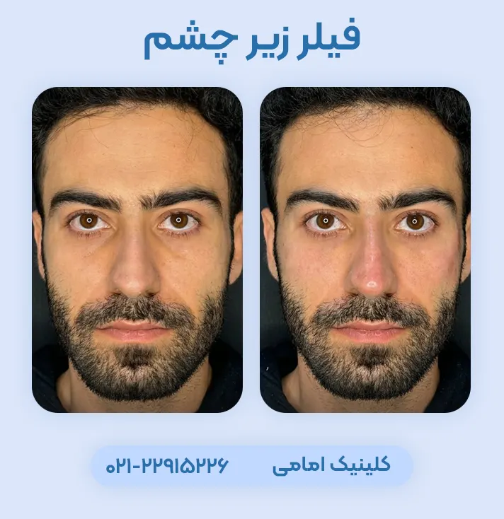 فیلر زیر چشم قبل و بعد