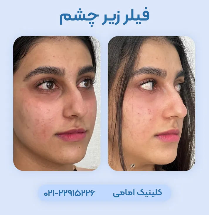 فیلر زیر چشم قبل و بعد