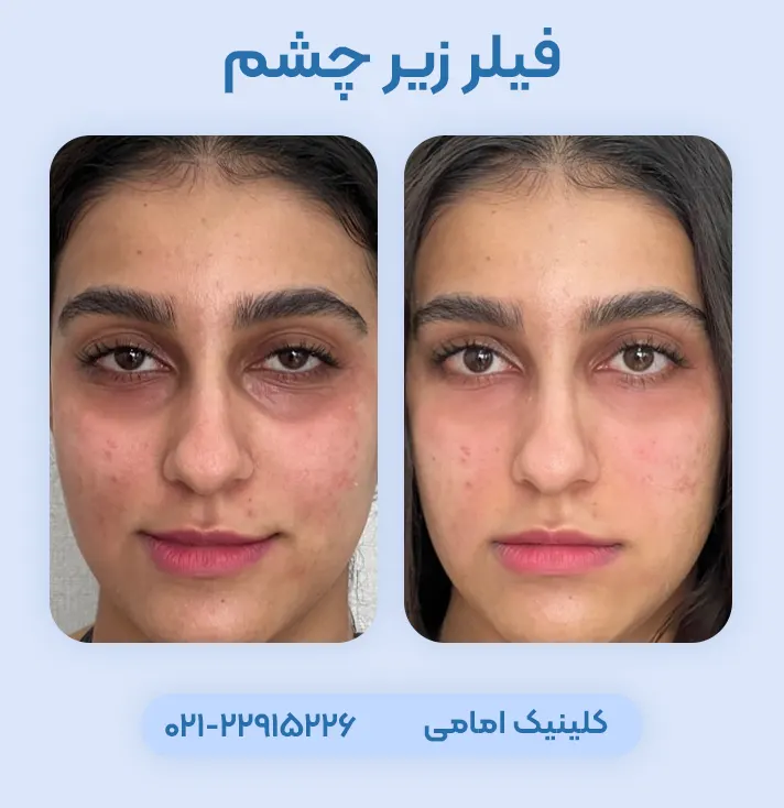فیلر زیر چشم قبل و بعد