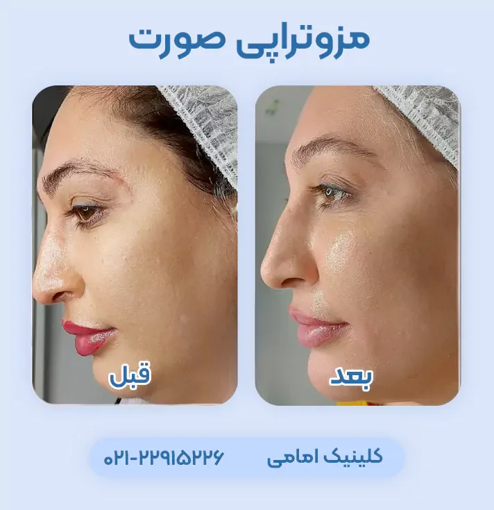 مزوتراپی صورت