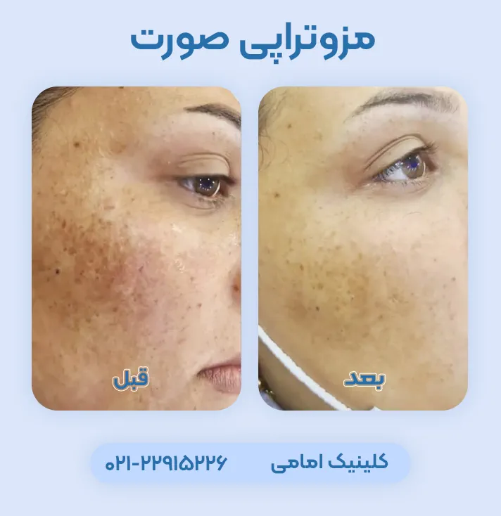 مزوتراپی صورت