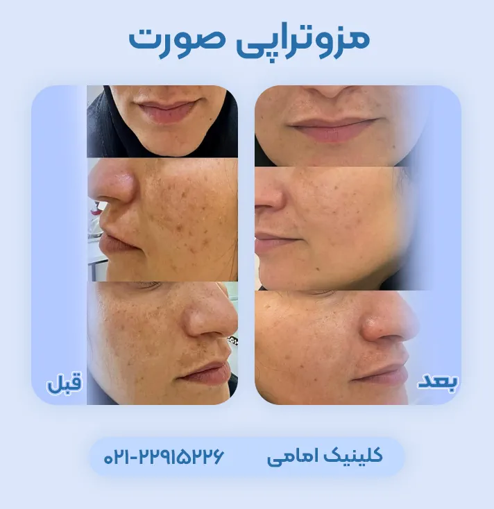 مزوتراپی صورت