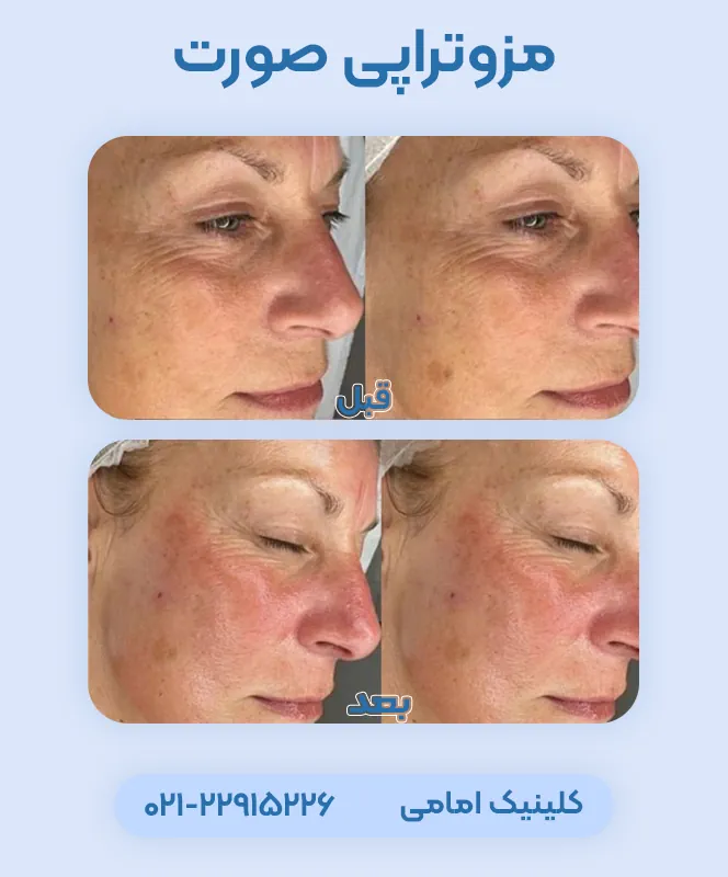 مزوتراپی صورت