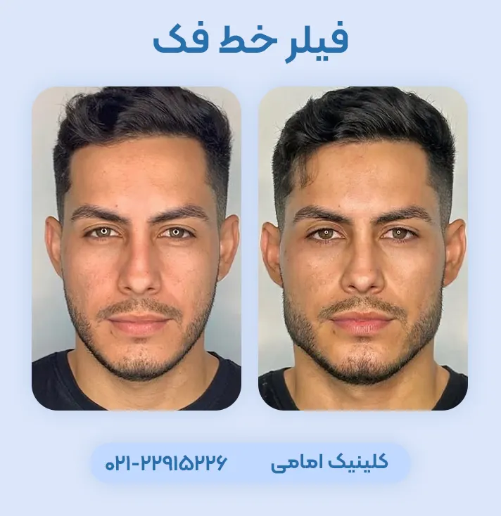 تزریق ژل خط فک اقایان