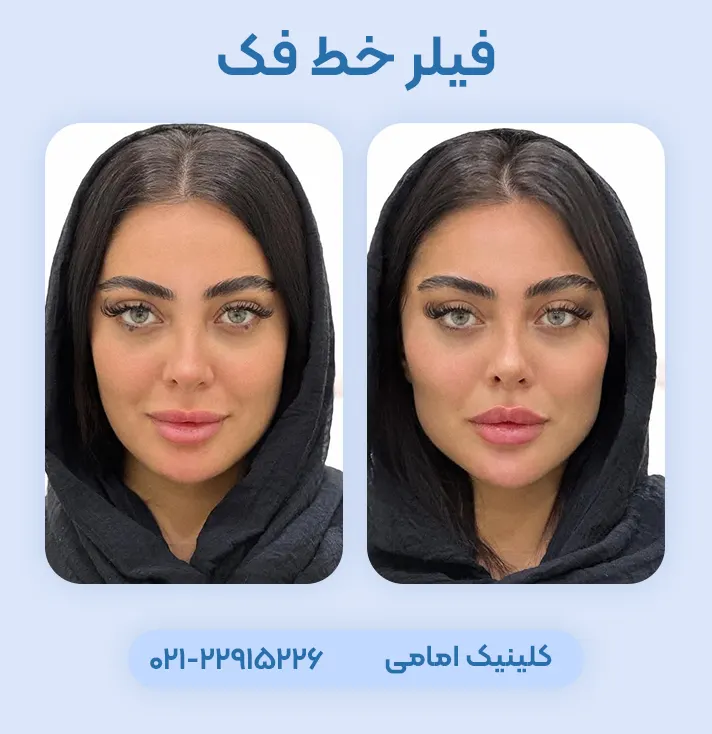 فیلر زاویه فک