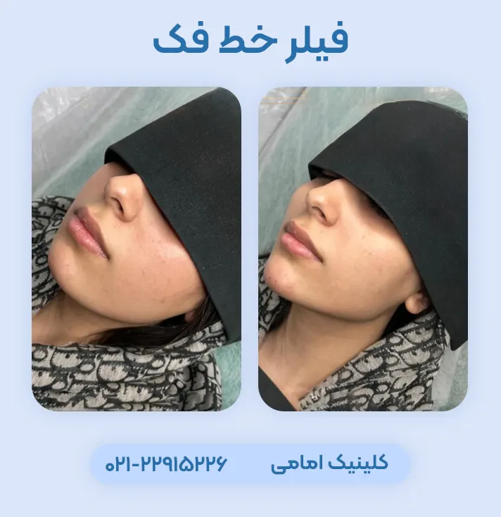 تزریق فیلر خط