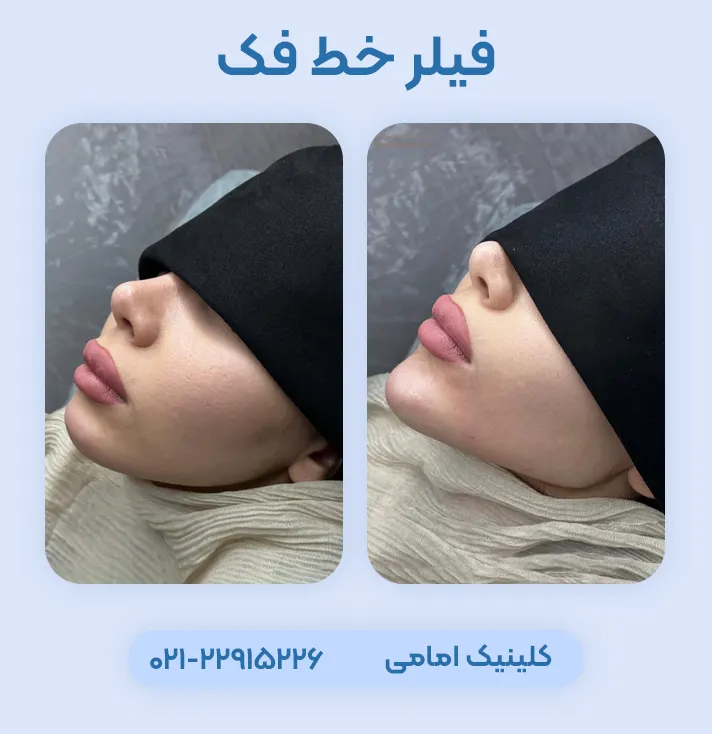 قبل بعد ژل خط فک