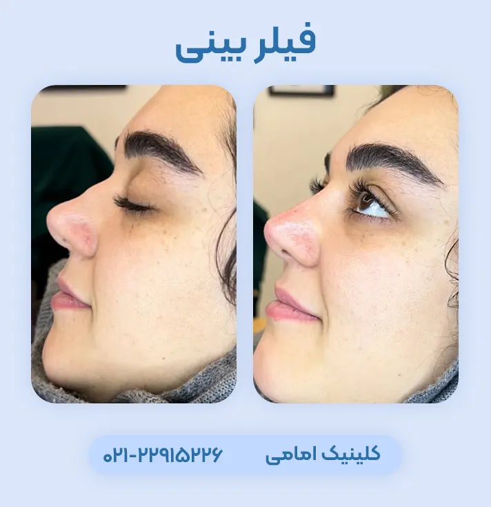 قبل و بعد ژل بینی