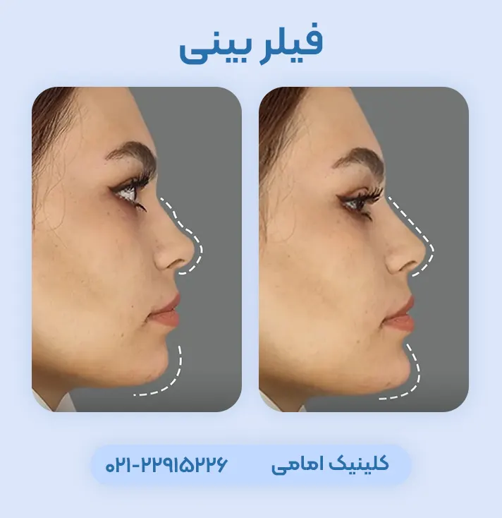 قبل و بعد ژل بینی