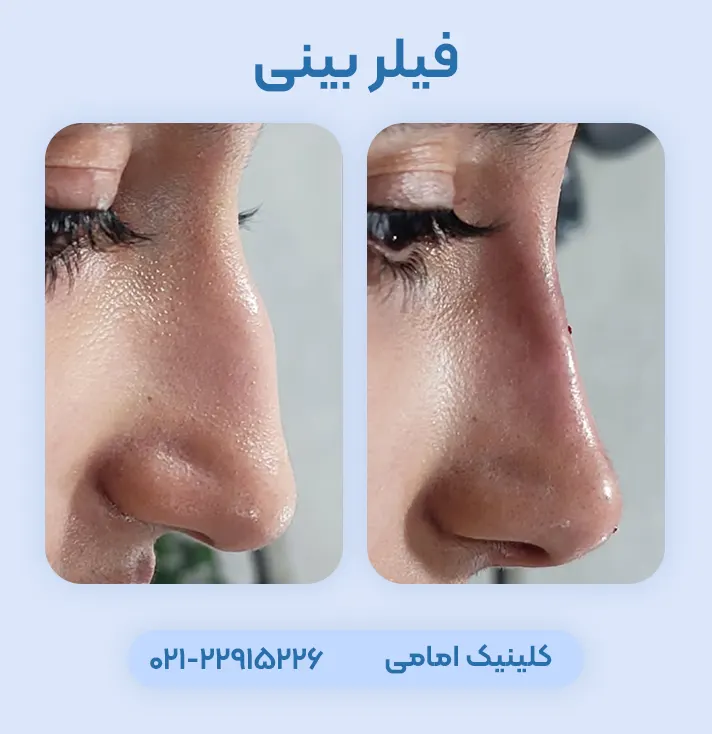 قبل و بعد فیلر بینی