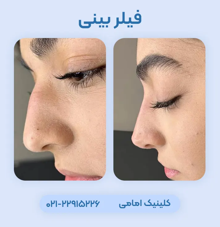 قبل و بعد تزریق ژل بینی