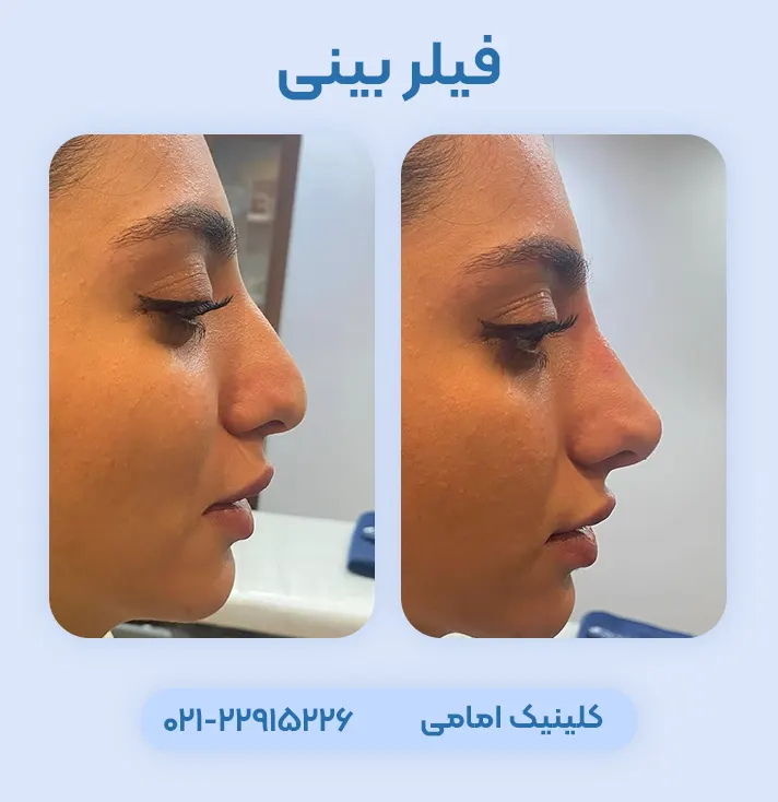 قبل و بعد فیلر بینی