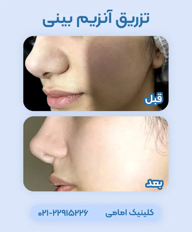 قبل و بعد آنزیم بینی