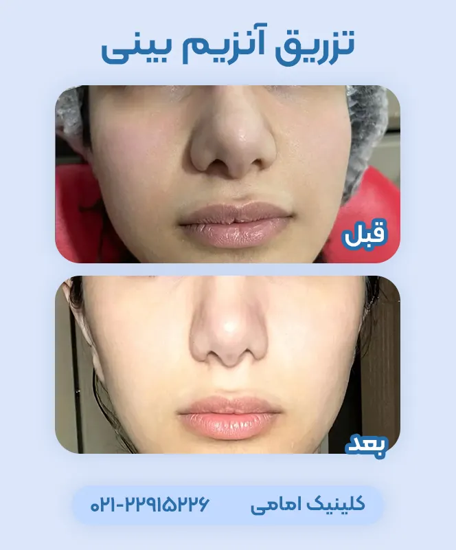 قبل و بعد آنزیم بینی