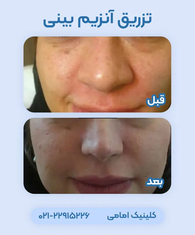 تزریق آنزیم بینی