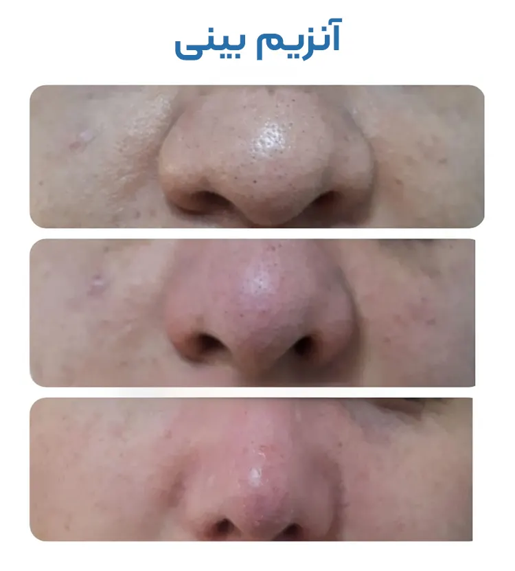 تزریق آنزیم بینی