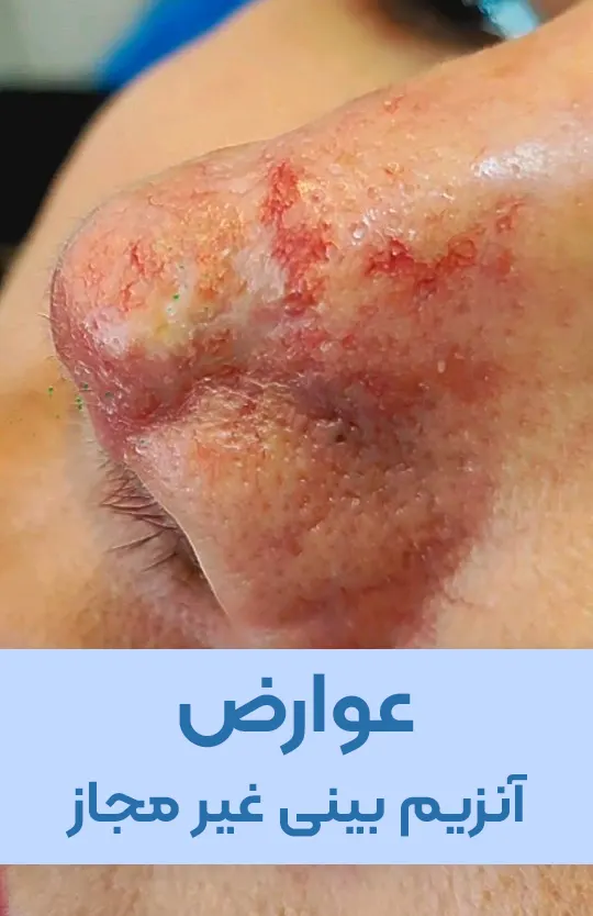 عوارض آنزیم بینی