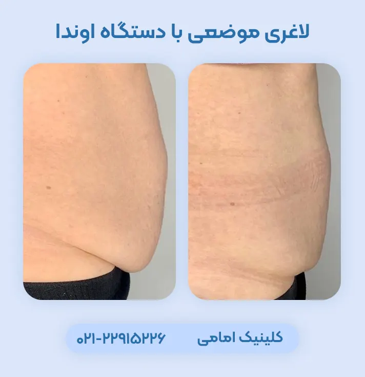 لاغری موضعی با دستگاه اوندا