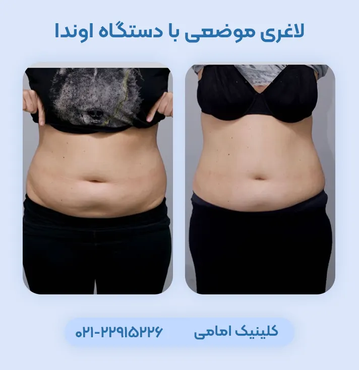 لاغری با دستگاه اوندا