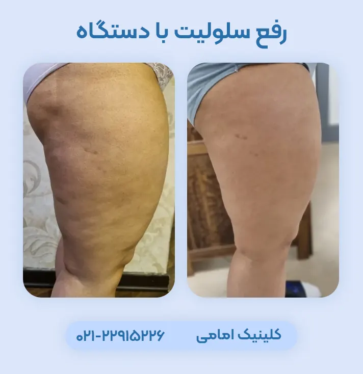 رفع سلولیت با دستگاه
