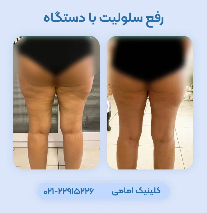 رفع سلولیت با دستگاه