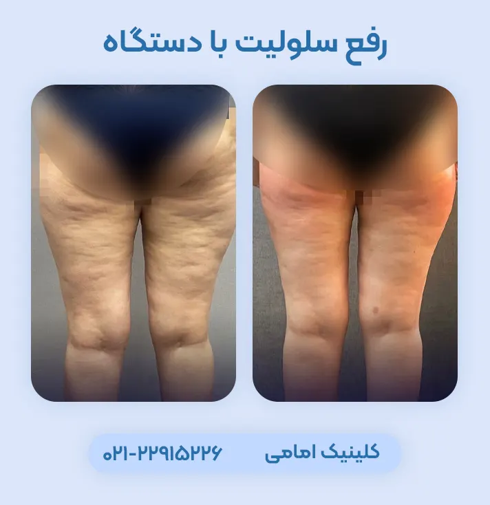 رفع سلولیت با دستگاه