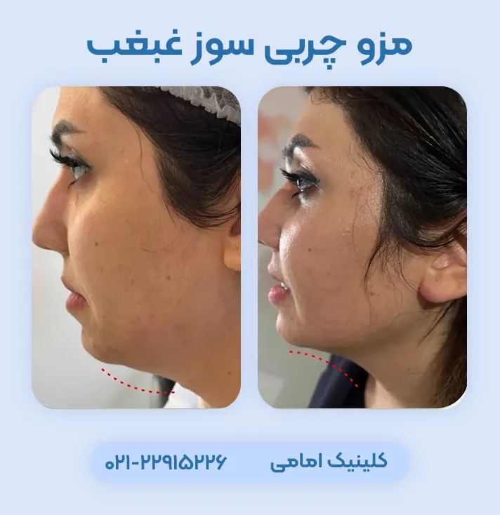 مزوتراپی غبغب