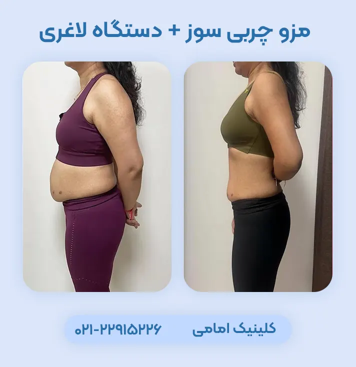 مزوتراپی چربی سوز