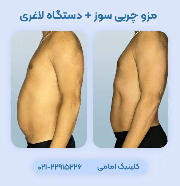 مزوتراپی چربی سوز