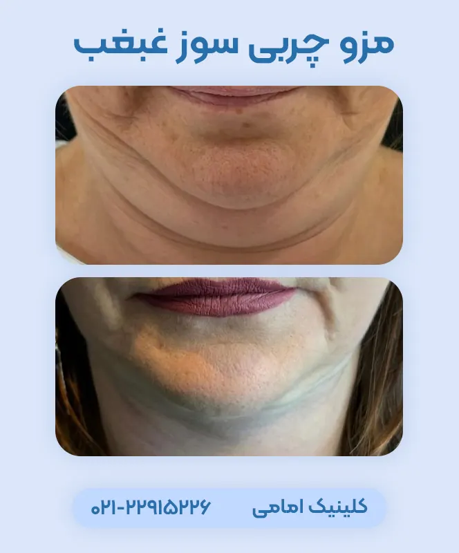 مزوتراپی چربی سوز غبغب