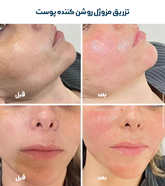 مزوژل برای شفافیت پوست