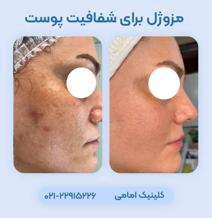 مزوژل برای شفافیت پوست