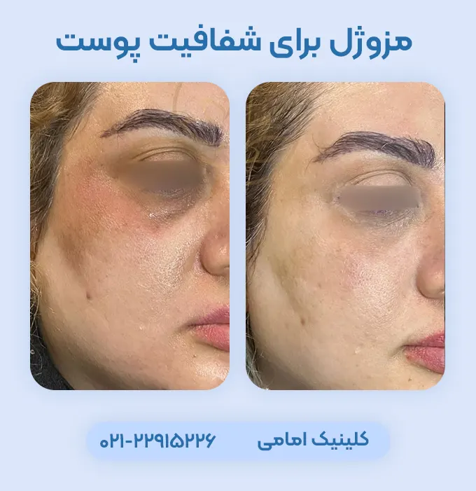 مزوژل برای شفافیت پوست