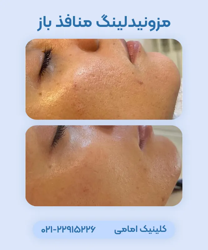درمان منافذ باز پوست با مزونیدلینگ