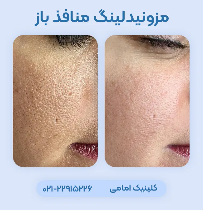 درمان منافذ باز پوست با مزونیدلینگ