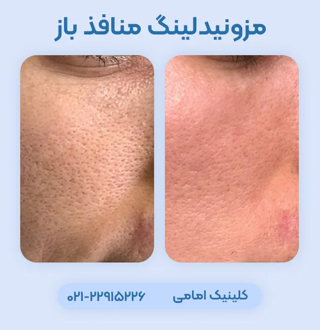 درمان منافذ باز پوست با مزونیدلینگ
