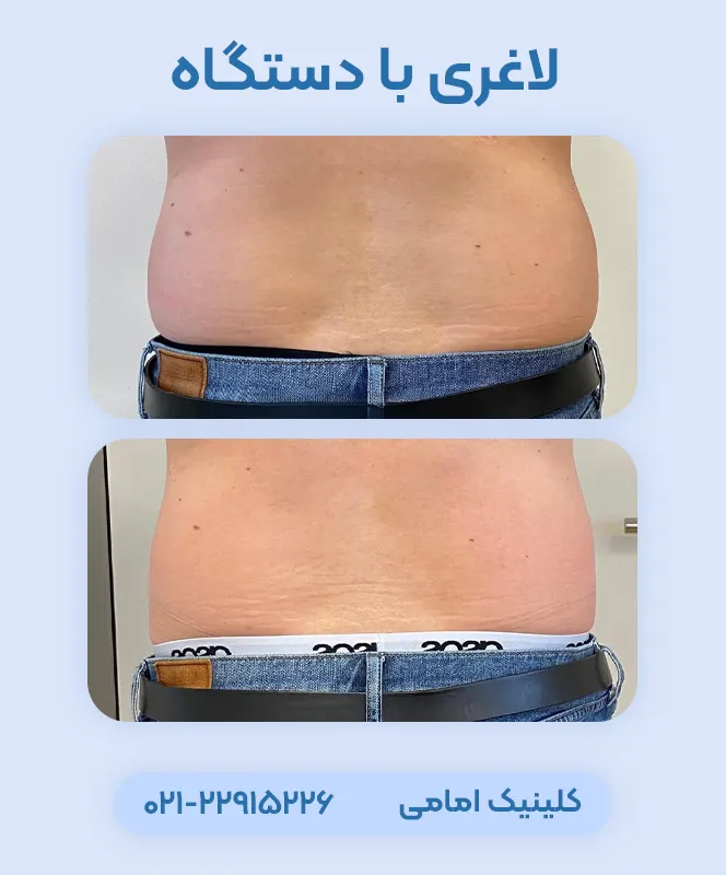 لاغری موضعی با دستگاه اسکالپشور