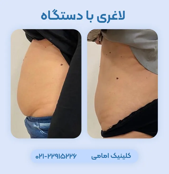 لاغری موضعی با دستگاه اسکالپشور