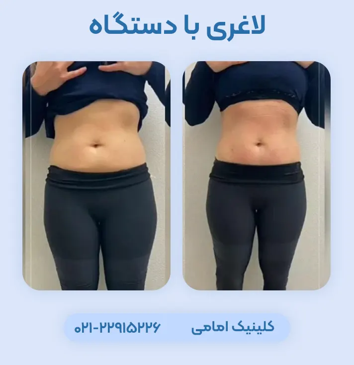 لاغری موضعی