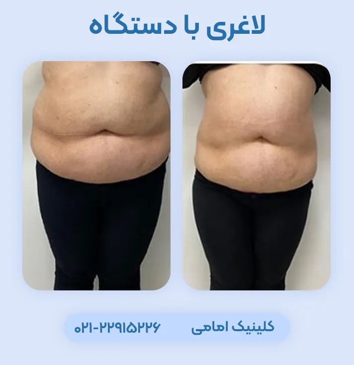 لاغری با دستگاه